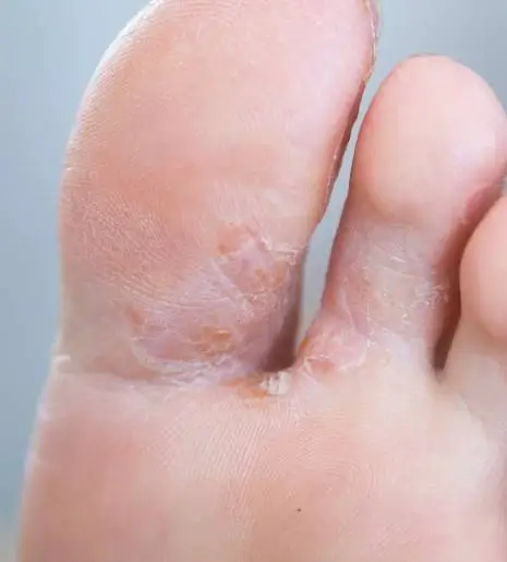 Itching between toes